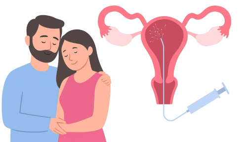 Внутрішньоматкова інсемінація: як працює і коли рекомендується? фото